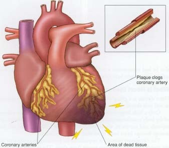Arteriosclerotic Heart Disease
