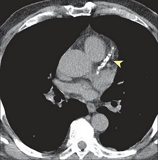 Atherosclerotic Calcification