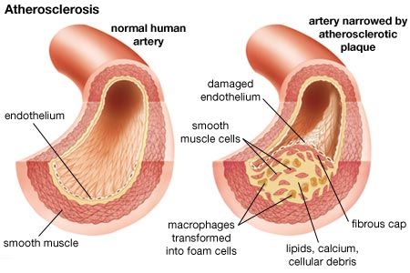 arteriosclerotic cardiovascular, arteriosclerotic cardiovascular disease